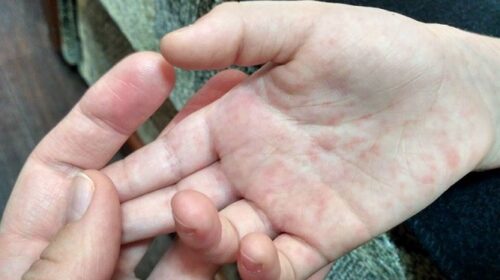 20 дітей у Києві захворіли на кір після відвідин цирку